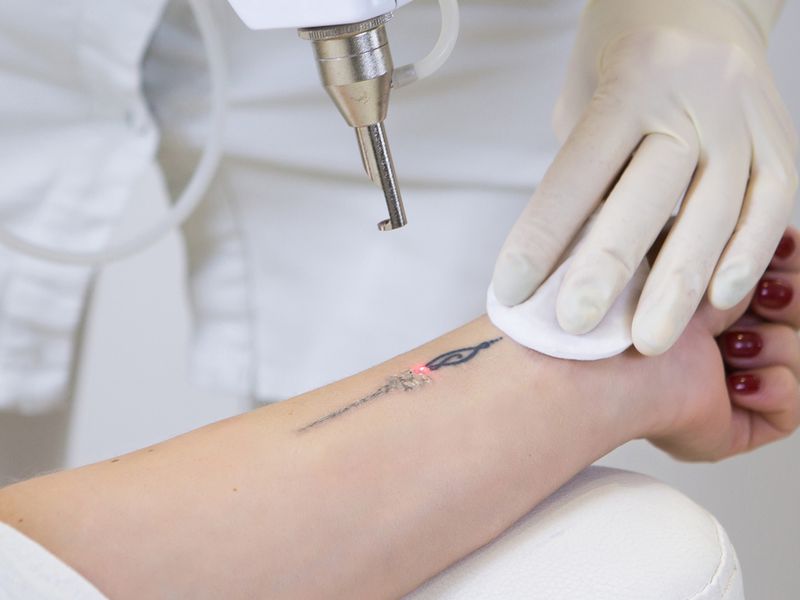 Laser Tattoo Removal Clinic  Prime Rosanna Location Low Overheads & High Margins