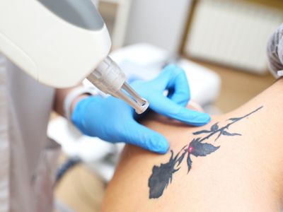 Laser Tattoo Removal Clinic  Offers Invited